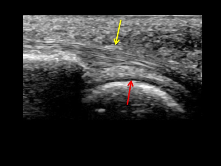 Figure 4 for case plantar plate of metatarsophalangeal joint ( RID3134 )